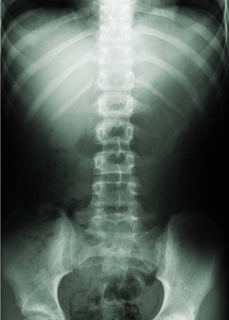 What Is Scoliosis 