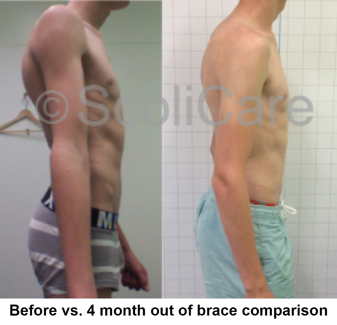 Superior in-brace correction achieved with a ScoliBrace